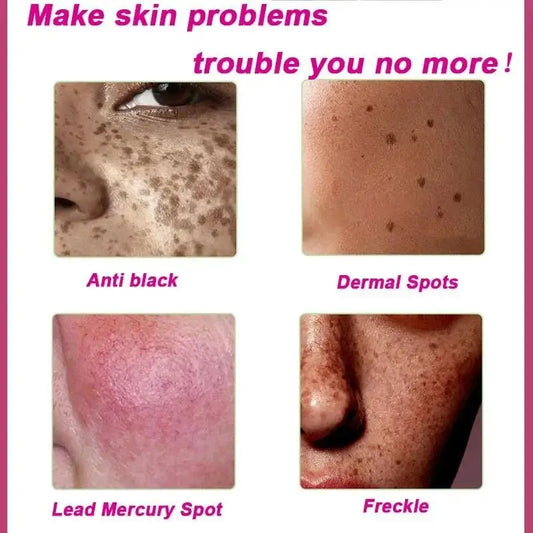 Dark Spots Remover Whitening Serum Face Freckle Melanin Correcting AntNiacinamide Facial Whitening Serum Moisturising Hyaluronic Acid Remove Dark Spots Acne Pockmarks Acne Pits Skin Care



▶Features:

●1.This facial moisturizing antiaDark Spots Remover Whitening Serum Face Freckle Melanin Correcting Anti Pigmentation Brighten Beauty Korean Day Night Skin Care