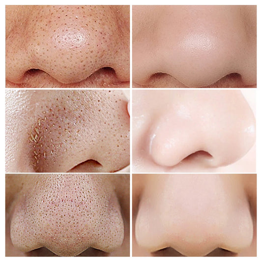LANBENA Face Serum Blackhead Remover Shrinking Pore Acne Treatment DeeUsed together, the effect is better Specialize in removing blackheads and shrinking pores LANBENA Green Tea Blackhead Remover Kit Deep Pore Cleaning  Pore ReducerPorLANBENA Face Serum Blackhead Remover Shrinking Pore Acne Treatment Deep Cleaning Smoothing Skin Care Firming Essence Beauty Set