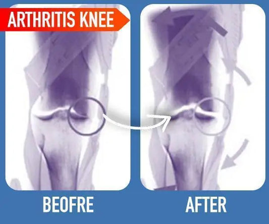Joint Arthritis PatchRelieve Joint Discomfort with the Arthritis PatchEase the pain of arthritis with the Arthritis Patch, designed to provide targeted relief to affected joints. This paJoint Arthritis Patch
